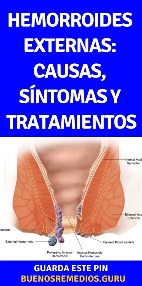 hemorroides externas fotos y videos|Todo sobre las Hemorroides Externas: Causas, Síntomas y